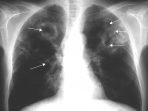 Pasiente TB Uza Osan Rasik ba Tratamentu